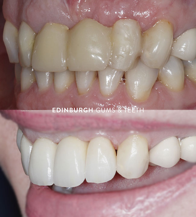 before and after of teeth whitening and straightening