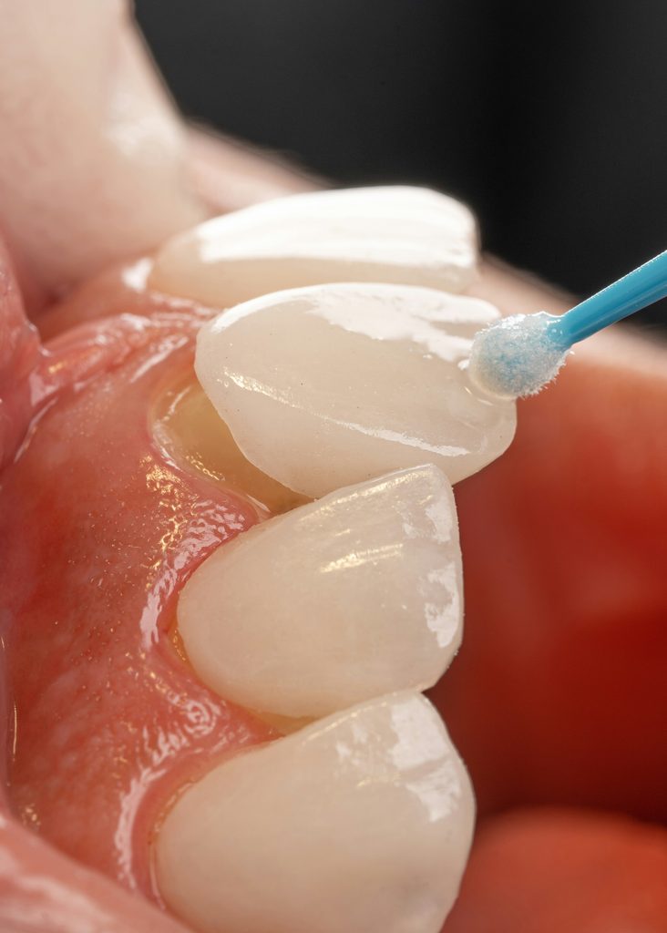 Dental veneers being fitted to enhance the patient's smile, while avoiding the 'turkey teeth' look that can make the smile look less natural and reduce its longevity.